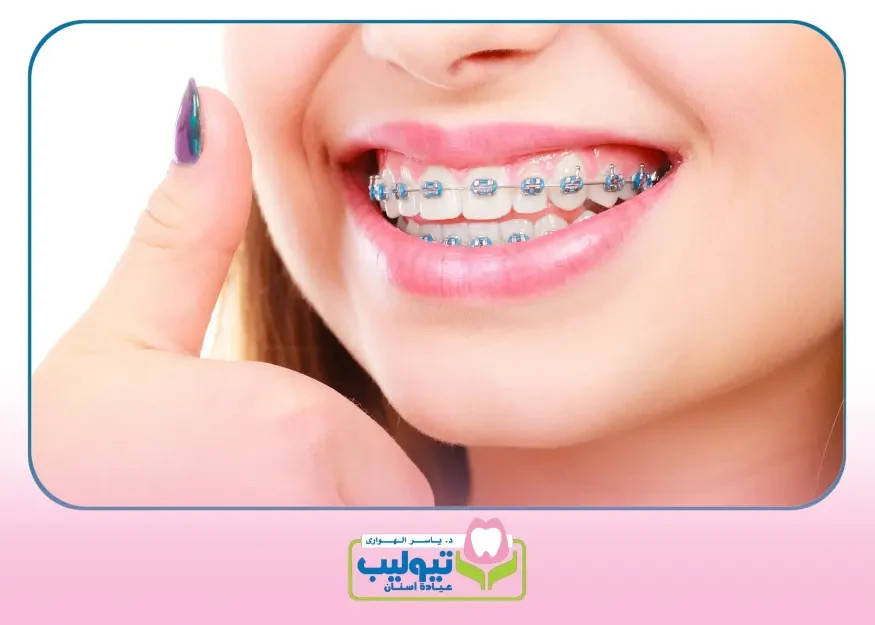 تعديل الأسنان بالتقويم image