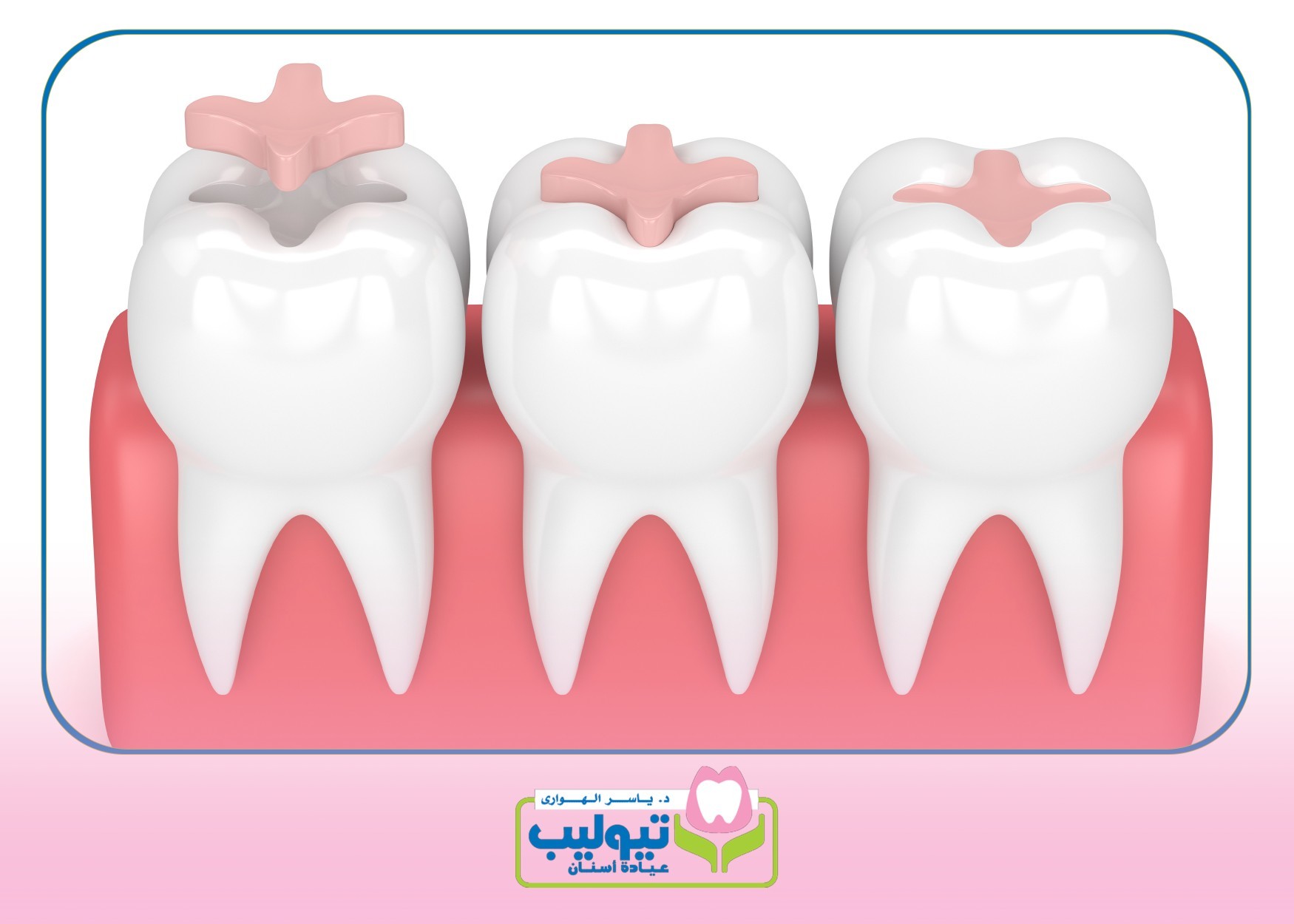 Cosmetic fillings image