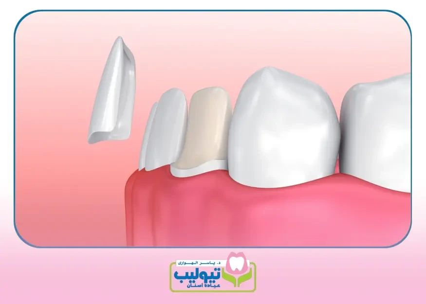 تعديل الأسنان بالتقويم image